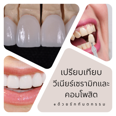 ข้อเปรียบเทียบโดยละเอียดระหว่าง วีเนียร์เซรามิก กับ วีเนียร์คอมโพสิท