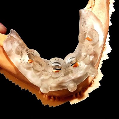 Edentulous planning & Surgical guide