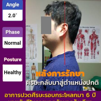 อาการปวดศีรษะเรื้อรังมาหลายปี หายได้ด้วยการนวดจัดกระดูกครั้งเดียว