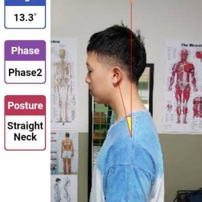 คุณแม่น้องวัย 17 ดีใจ ลูกชายกระดูกสันหลังคดและคอยื่นดีขึ้นมาก 