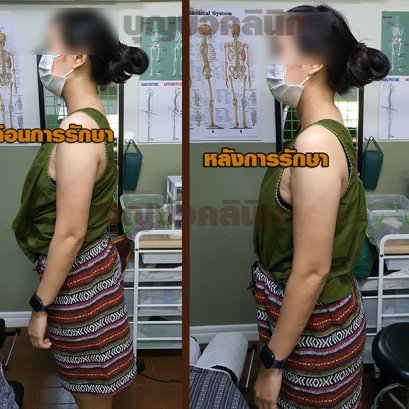 การรักษา ก้นงอน หลังแอ่น ท้องยื่น 