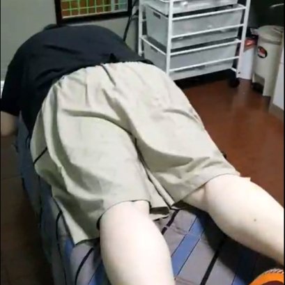 การรักษาผู้ป่วยภาวะหมอนรองกระดูกทับเส้นประสาท ปวดร้าวลงขา