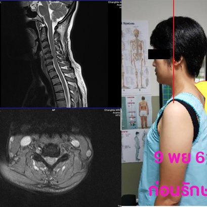 มาด้วยอาการออฟฟิศซินโดรม แต่ตรวจแล้วเป็นกระดูกคอเสื่อมทับเส้นประสาท