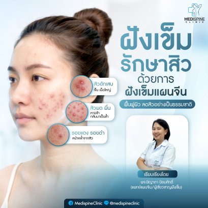 ฝังเข็มรักษาสิว: ฟื้นฟูผิวสวย ลดสิวเรื้อรังจากภายในด้วยศาสตร์แพทย์แผนจีน