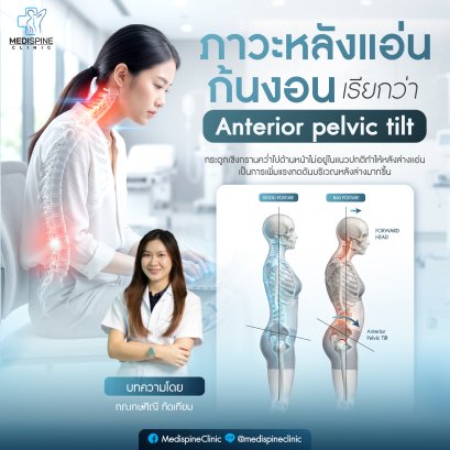 ปวดหลังล่างไม่หาย? อาจเป็นเพราะ "ภาวะกระดูกเชิงกรานคว่ำ" (Anterior Pelvic Tilt) เช็กวิธีแก้ด้วยตัวเอง