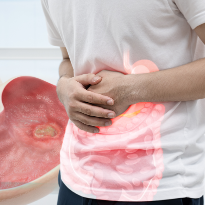 แผลในกระเพาะอาหาร