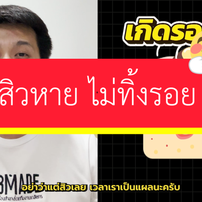 พอมีวิธีมั้ยที่เป็นสิวแล้ว ไม่ต้องเป็นรอยสิวร่วมด้วย