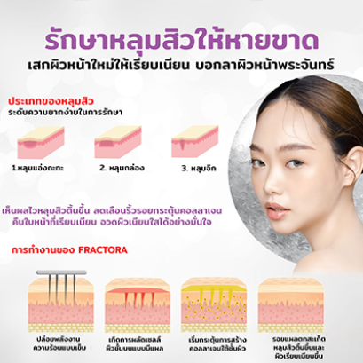 FRACTORA นวัตกรรมใหม่ล่าสุด ของการรักษาหลุมสิว