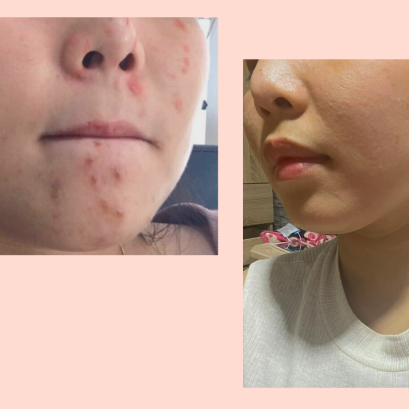 วิธีรักษาสิวสำหรับผิวแพ้ง่าย