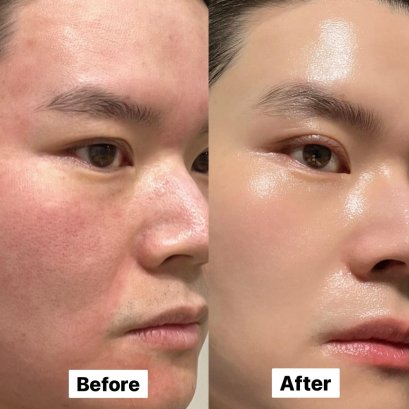 ครั้งแรกกับ Venus Viva MD รูขุมขนเบียด By เราใช้แต่ของดี