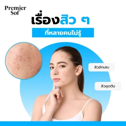 เรื่องสิว ๆ ที่หลายคนไม่รู้