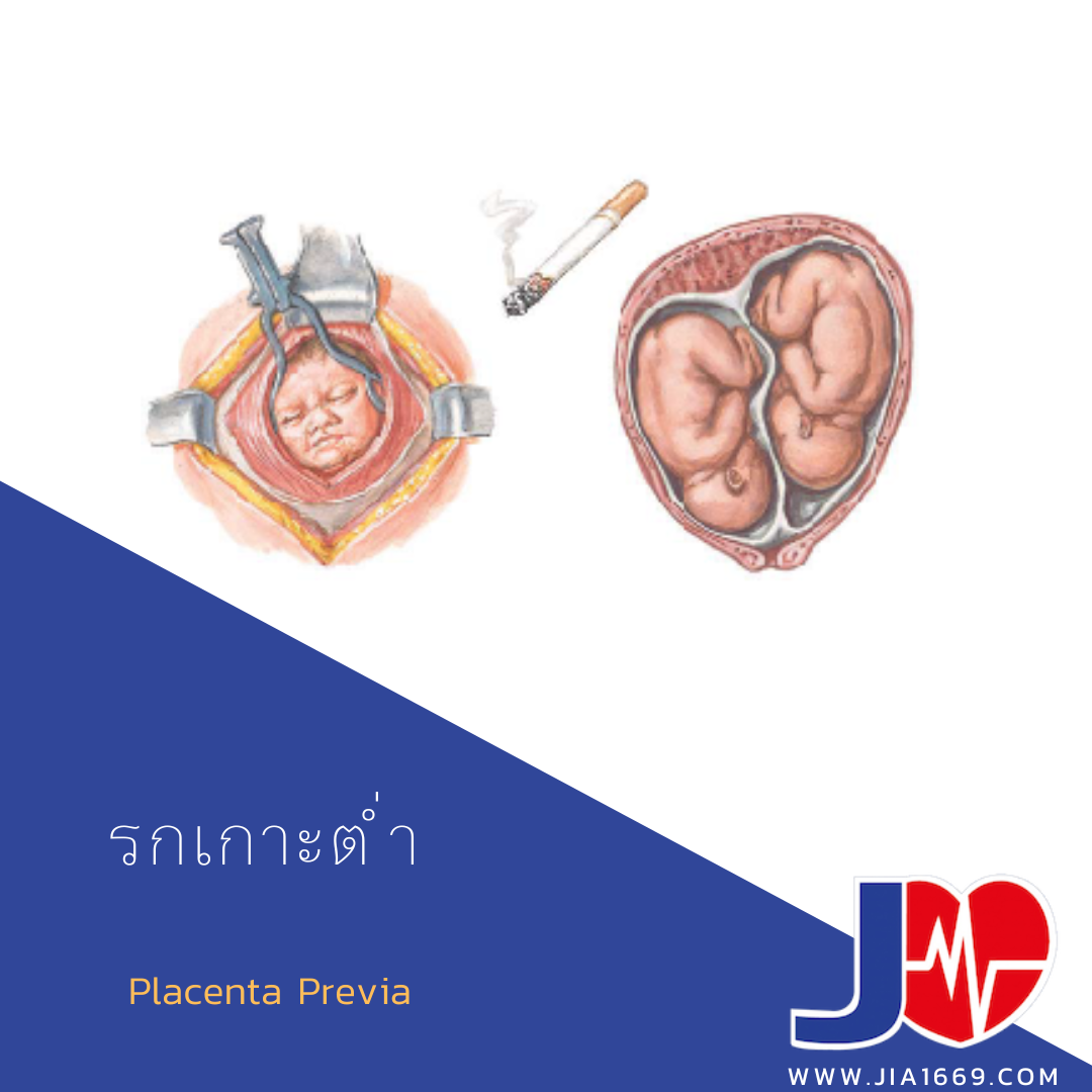 Placenta Previa - jia1669