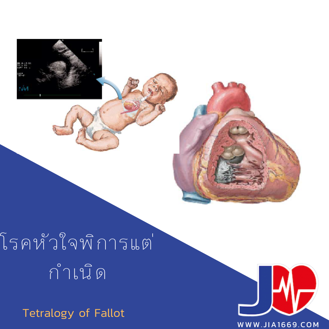 โรคหัวใจพิการแต่กำเนิด Jia1669