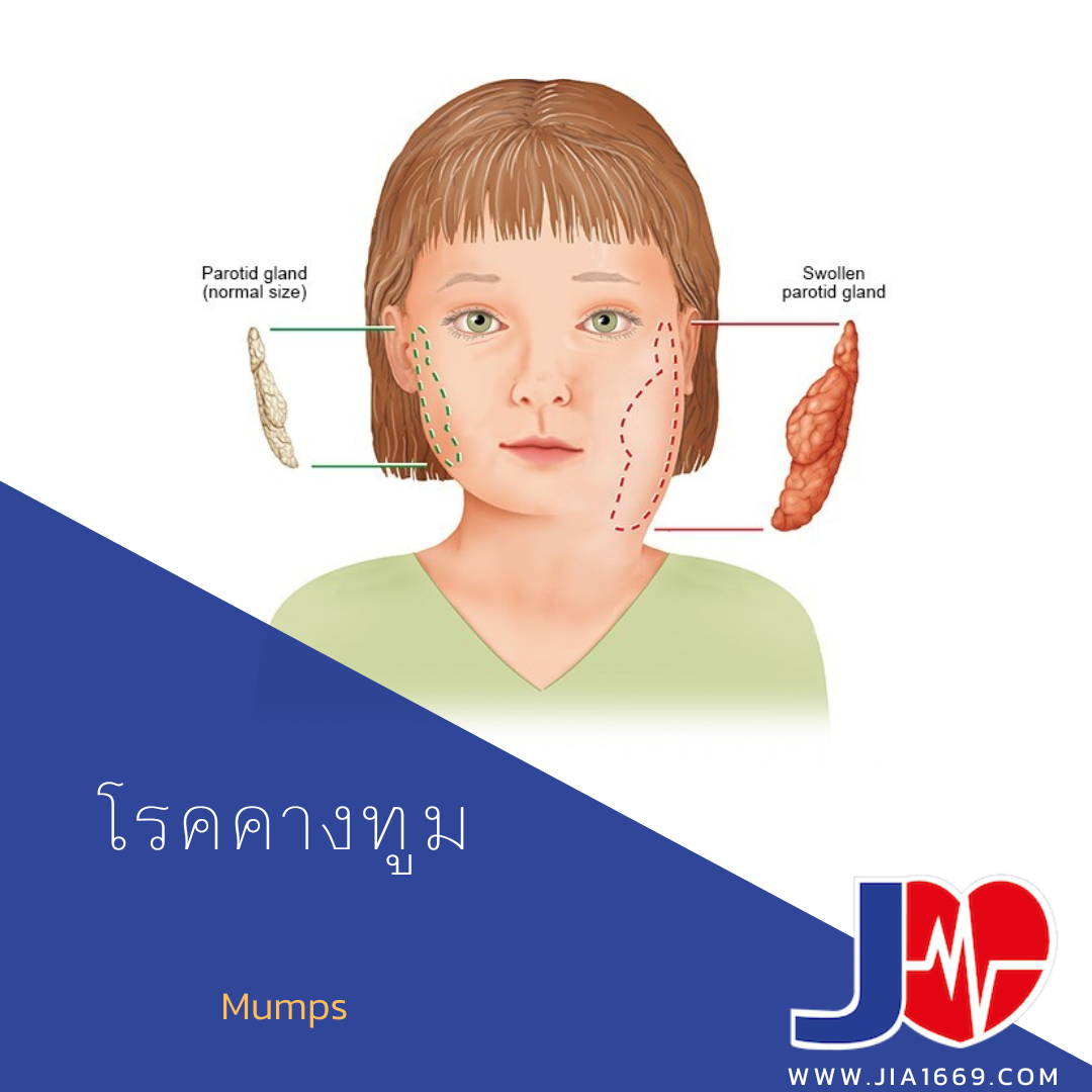 โรคคางทูม - jia1669