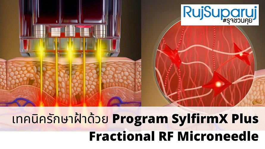 Rf Program เทคนิครักษาฝ้าด้วย Program SylfirmX Plus Fractional RF Microneedle