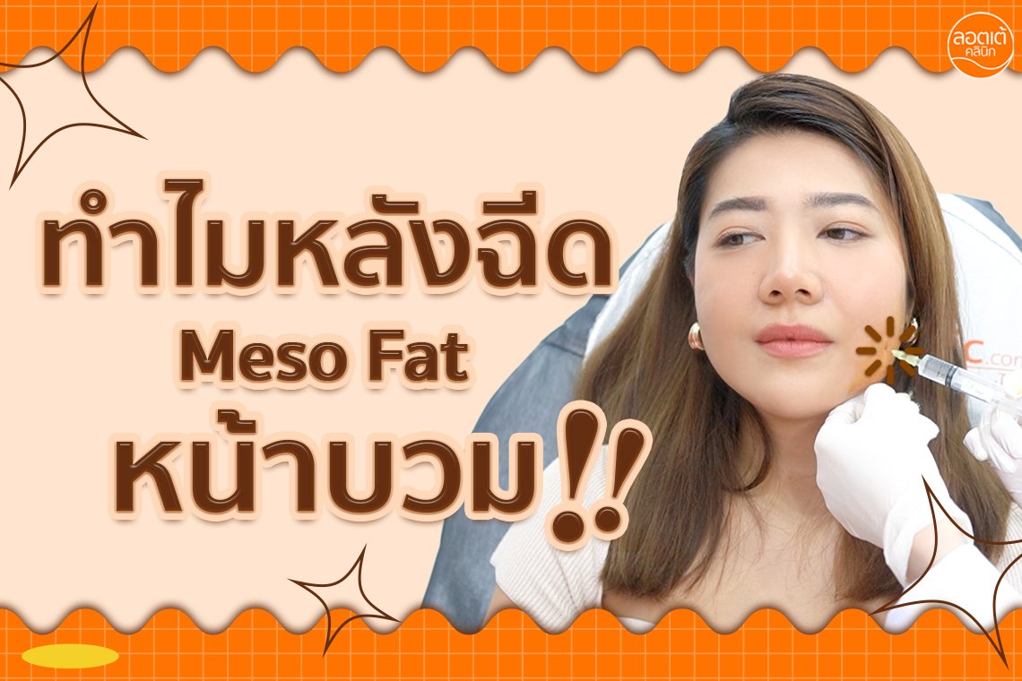 สาเหตุหน้าบวมหลังฉีด Meso Fat