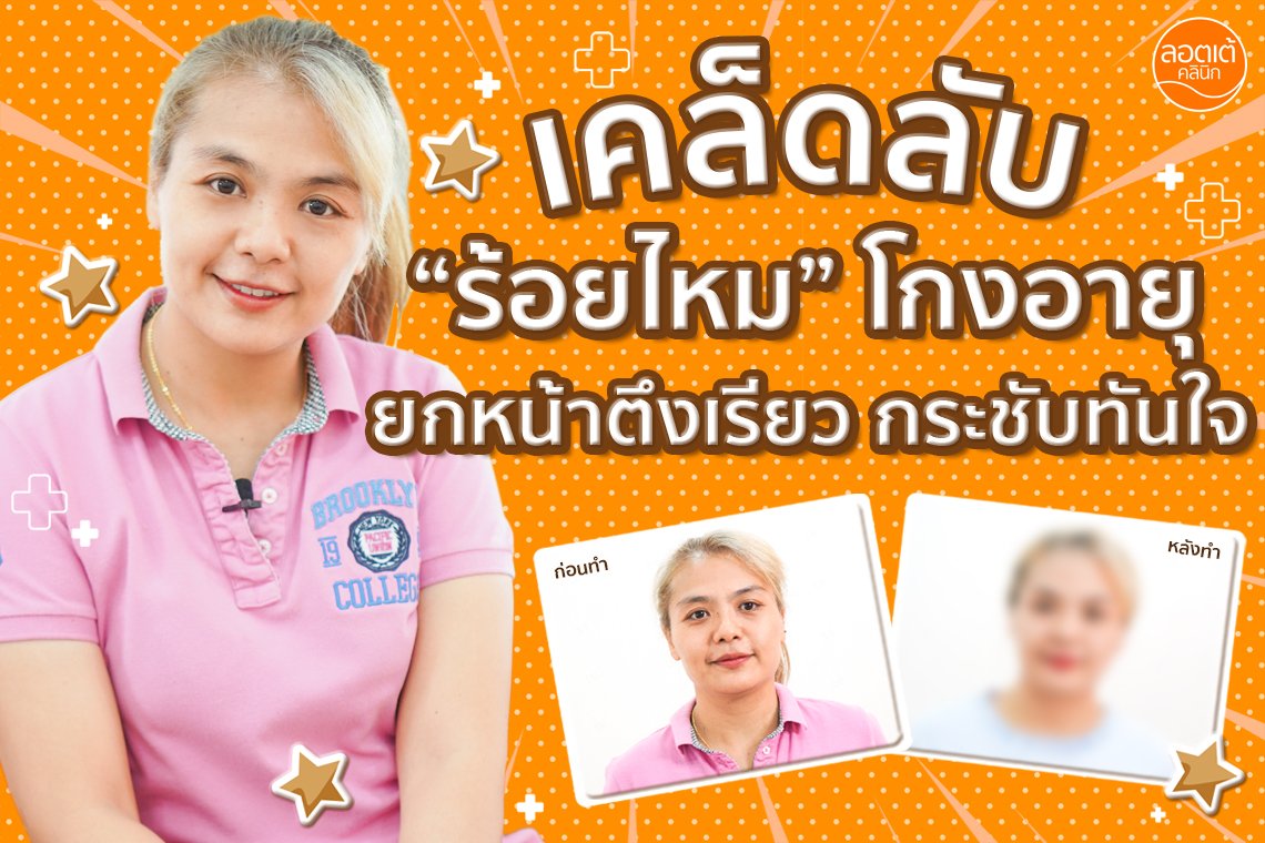 เคล็ดลับ “ร้อยไหม” โกงอายุยกหน้าตึงเรียวกระชับทันใจ