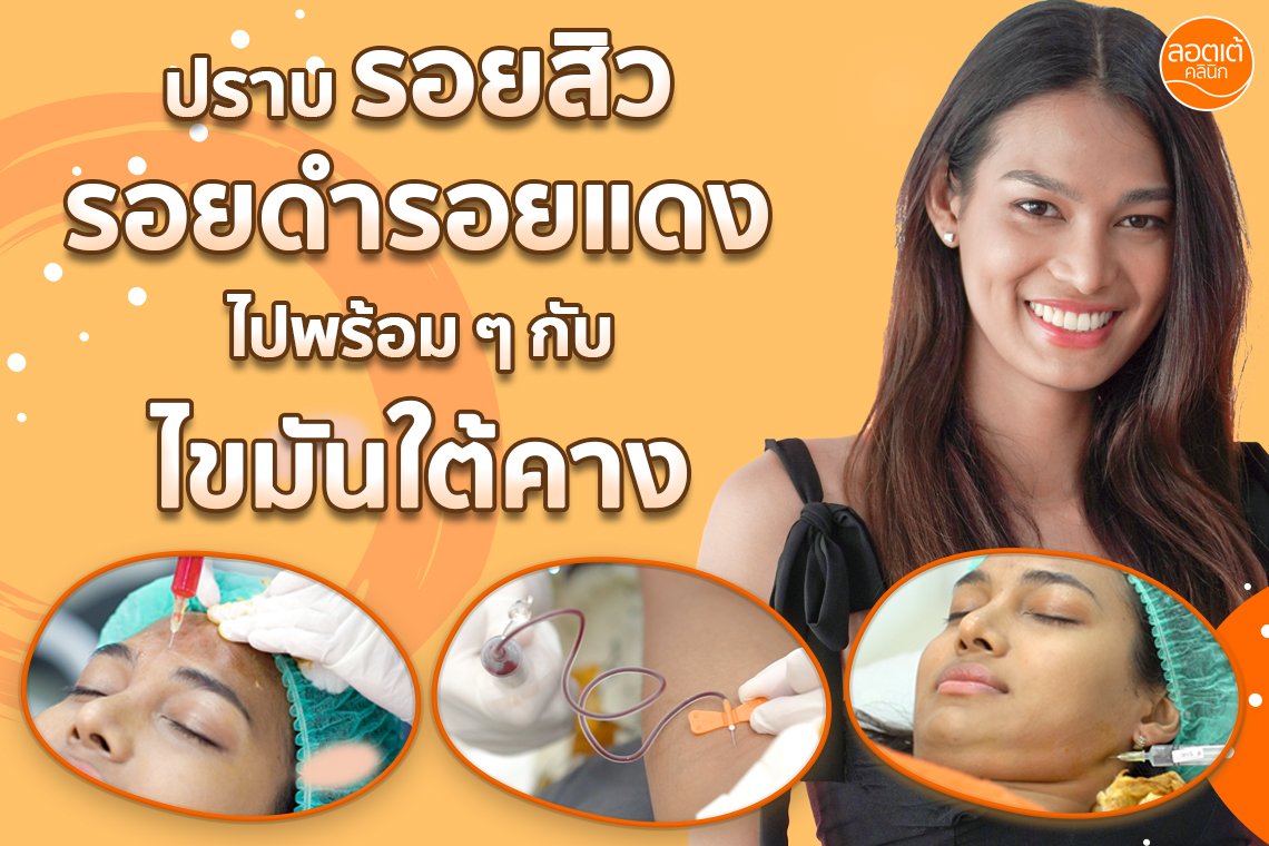 ทำโปรแกรมหน้าใสด้วยเกล็ดเลือดตัวเอง พร้อมกับ โปรแกรมสลายไขมัน ผลเป็นยังไงนะ ? ทำโปรแกรมหน้าใสด้วยเกล็ดเลือดตัวเอง พร้อมกับ โปรแกรมสลายไขมัน ผลเป็นยังไงนะ ?