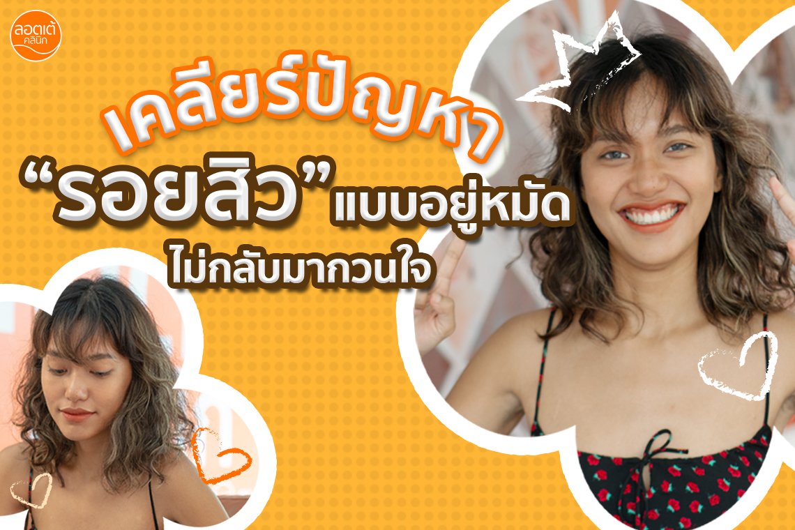 เบื่อไหมกับผิวหน้าหมองคล้ำ รอยสิวที่ฝังลึก เบื่อไหมกับผิวหน้าหมองคล้ำ รอยสิวที่ฝังลึก