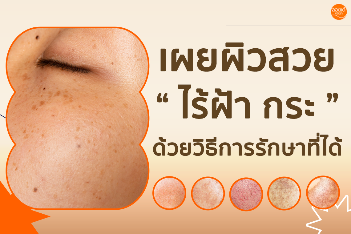 เผยผิวสวยไร้ฝ้า กระ ด้วยวิธีการรักษาที่ได้ เผยผิวสวยไร้ฝ้า กระ ด้วยวิธีการรักษาที่ได้