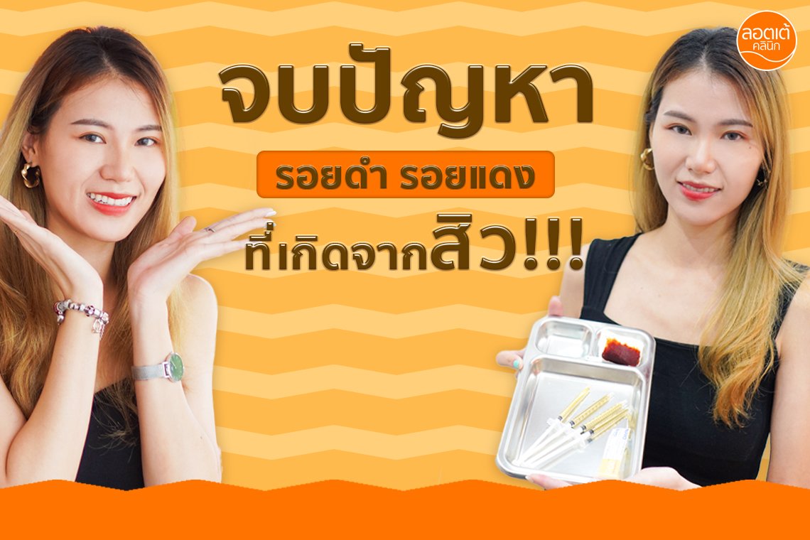 จบปัญหารอยดำจากสิว ด้วยเกล็ดเลือดของคุณเอง!!! จบปัญหารอยดำจากสิว ด้วยเกล็ดเลือดของคุณเอง!!!