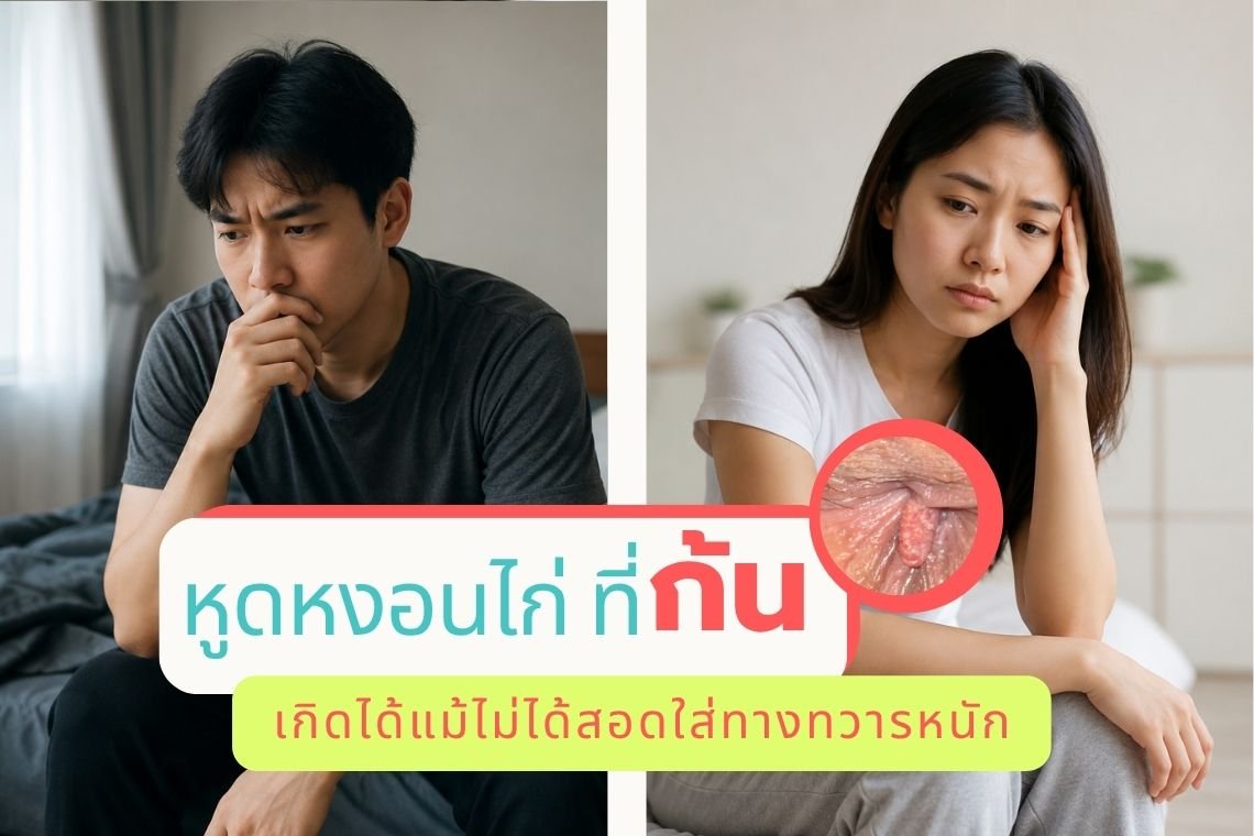หูดหงอนไก่ที่ก้น เกิดได้แม้ไม่ได้สอดใส่ทางทวารหนัก