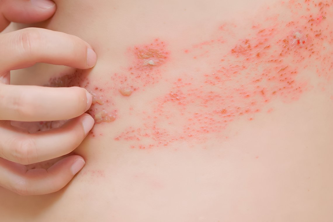 งูสวัดพันรอบตัวแล้วตายจริงไหม ? 