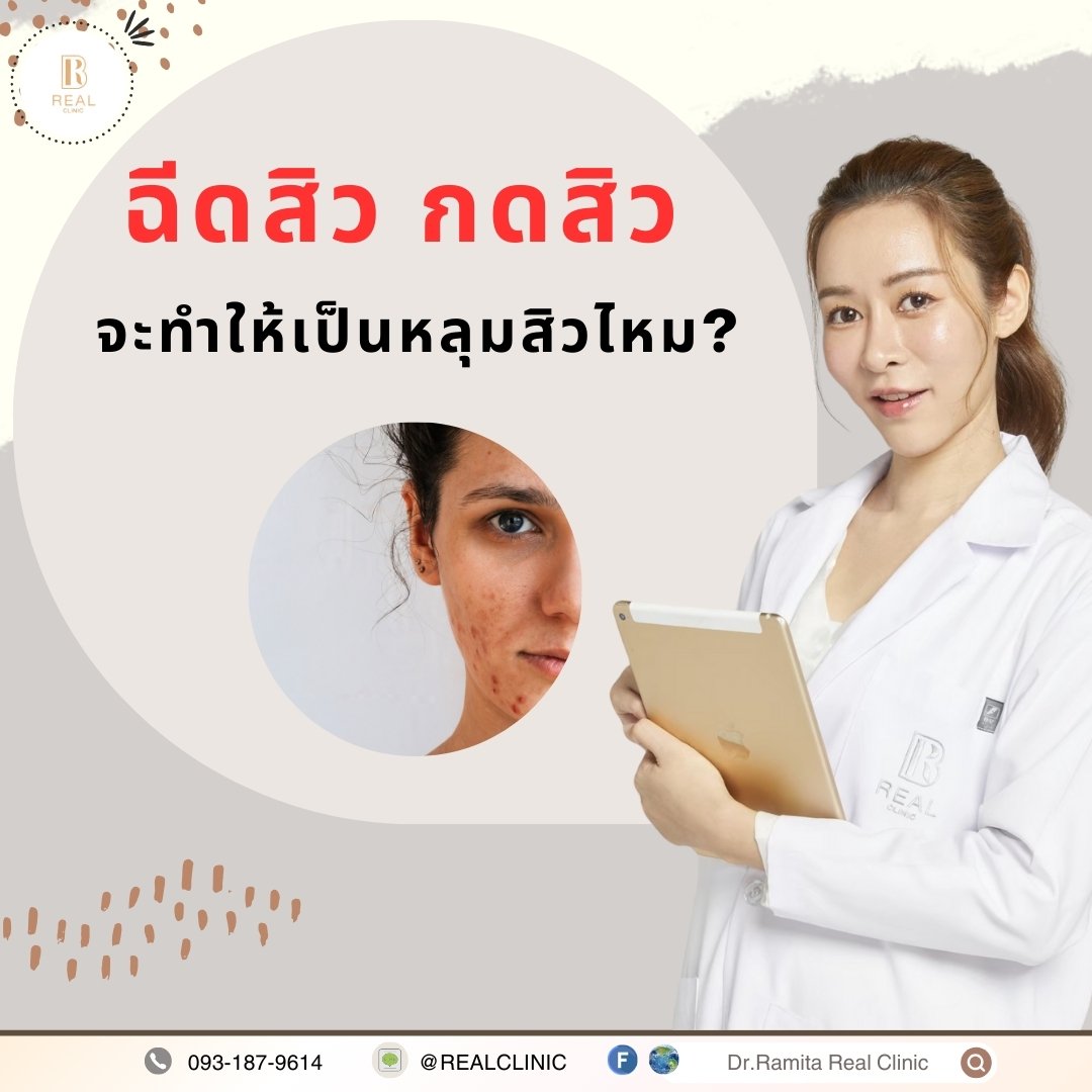 รักษาสิวอย่างไรดีที่สุด การฉีดสิว กดสิว ทำให้กลายเป็นหลุมสิวหรือไม่ ทำให้สิวหายไวขึ้นไหม