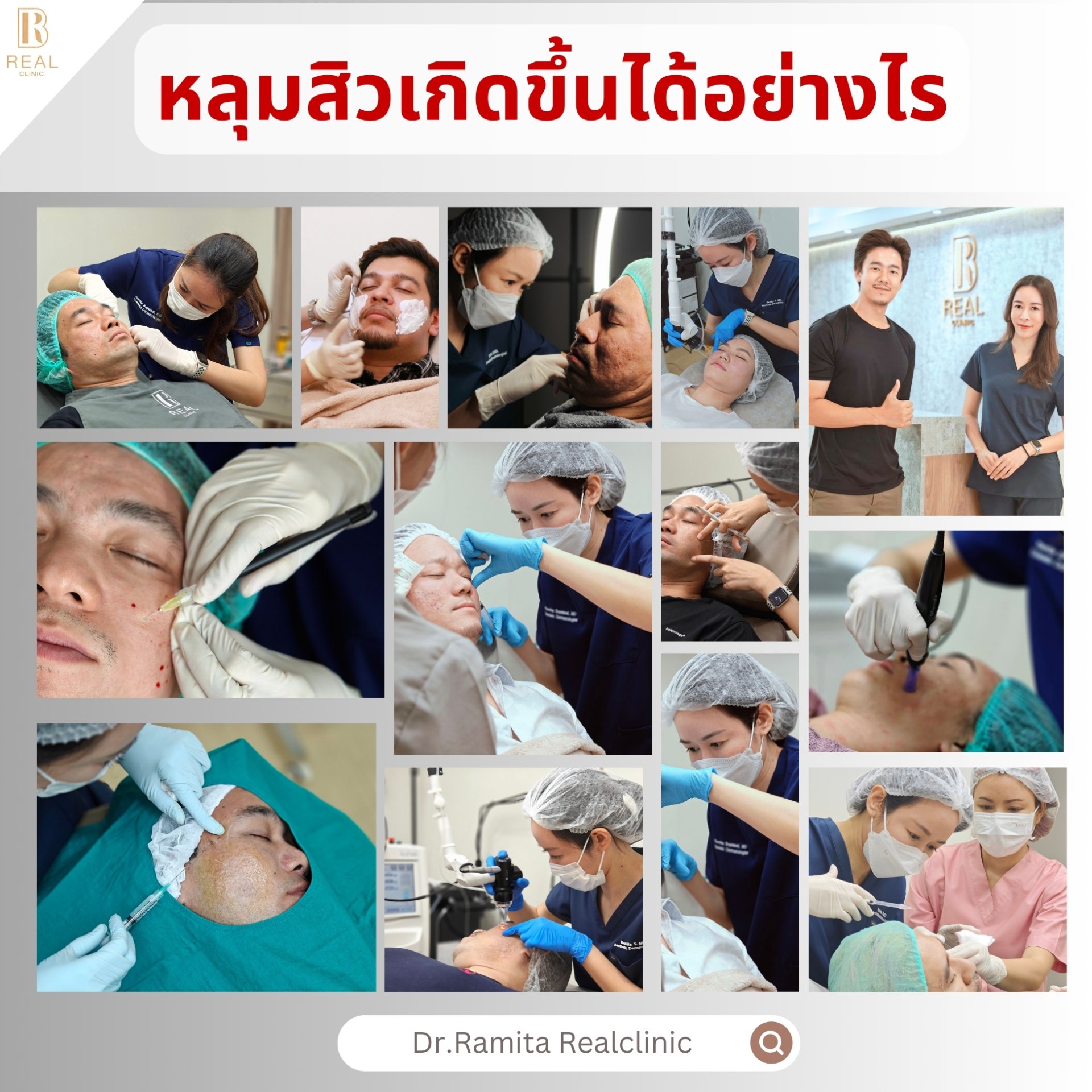 หลุมสิวเกิดจากอะไร มาดูกันว่าเหตุใดและอย่างไรหลุมสิวจึงเกิดขึ้นในเชิงลึก