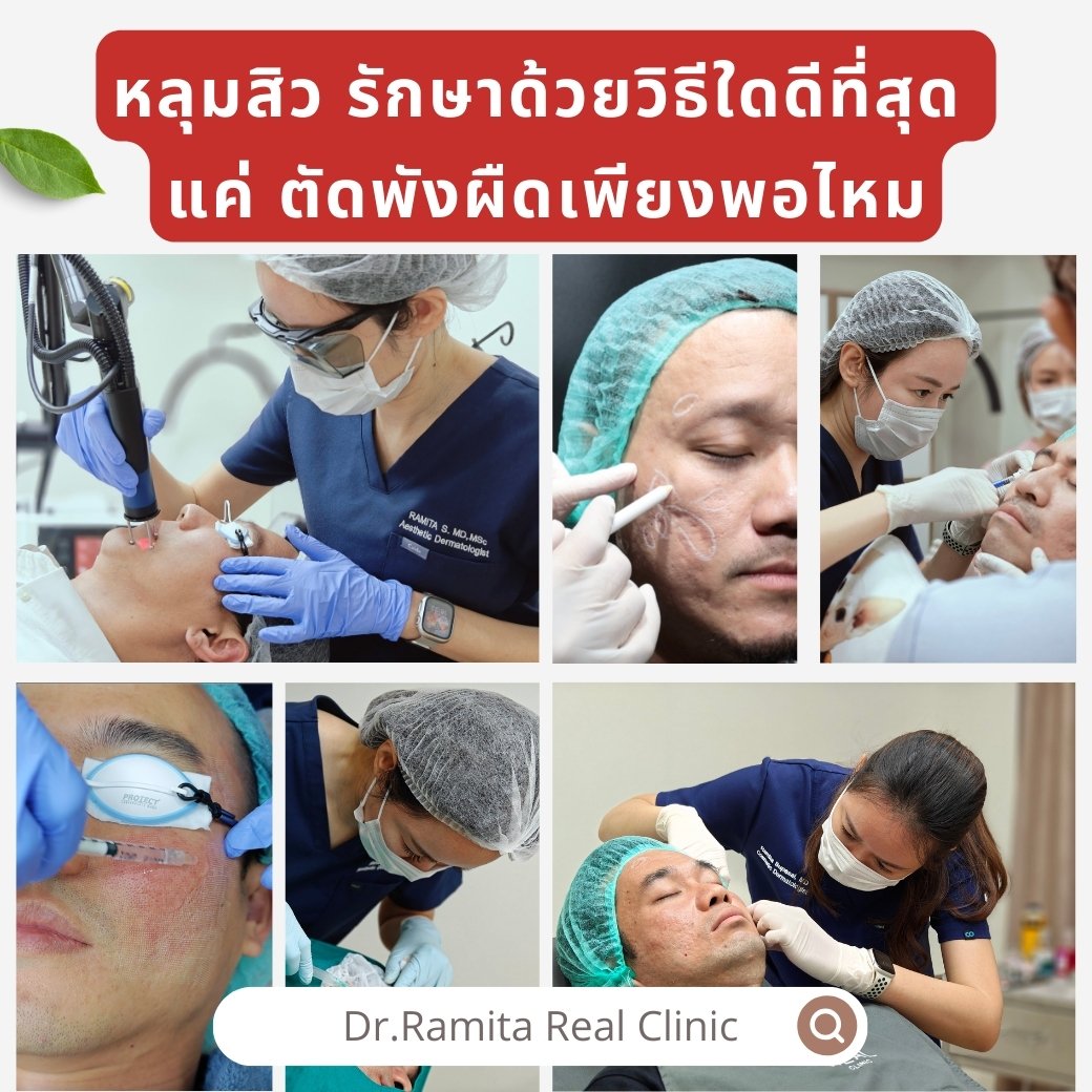 หลุมสิว* รักษาหลุมสิวด้วยการทำ Subcision (การตัดพังผืด) เพียงพอแล้วรึไม่ ถ้าต้องการผลลัพธ์ที่ดียิ่งกว่ามีวิธีไหนอีกบ้าง?