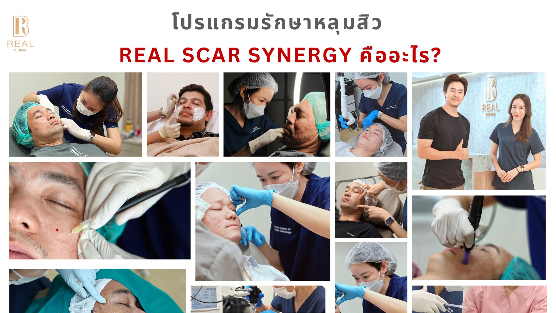 รักษาหลุมสิว,ตัดพังผืด,รักษาหลุมสิว, วิธีรักษาหลุมสิว, Fractional Laser, Microneedling, Subcision, เติมฟิลเลอร์, Real Scar Synergy, Juvgen,acnescarsurgery,acnescarrevision,รักษาหลุมสิวให้ตื้น,เลเซอร์หลุมสิว, รักษาหลุมสิวที่ดีที่สุด,รักษาหลุมสิวให้หายขาด,ห