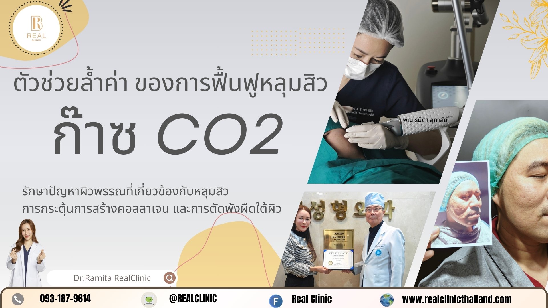 การใช้ก๊าซคาร์บอนไดออกไซด์ (CO2) ในความงามและการรักษาหลุมสิว 2025