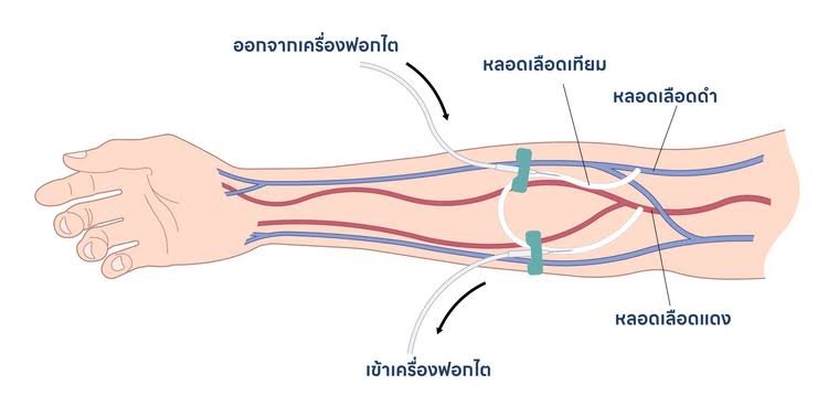 ข้อปฎิบัติตัวสำหรับผู้ป่วยระยะหลังผ่าตัด ที่ทําการตัดต่อเส้นเลือดที่แขน