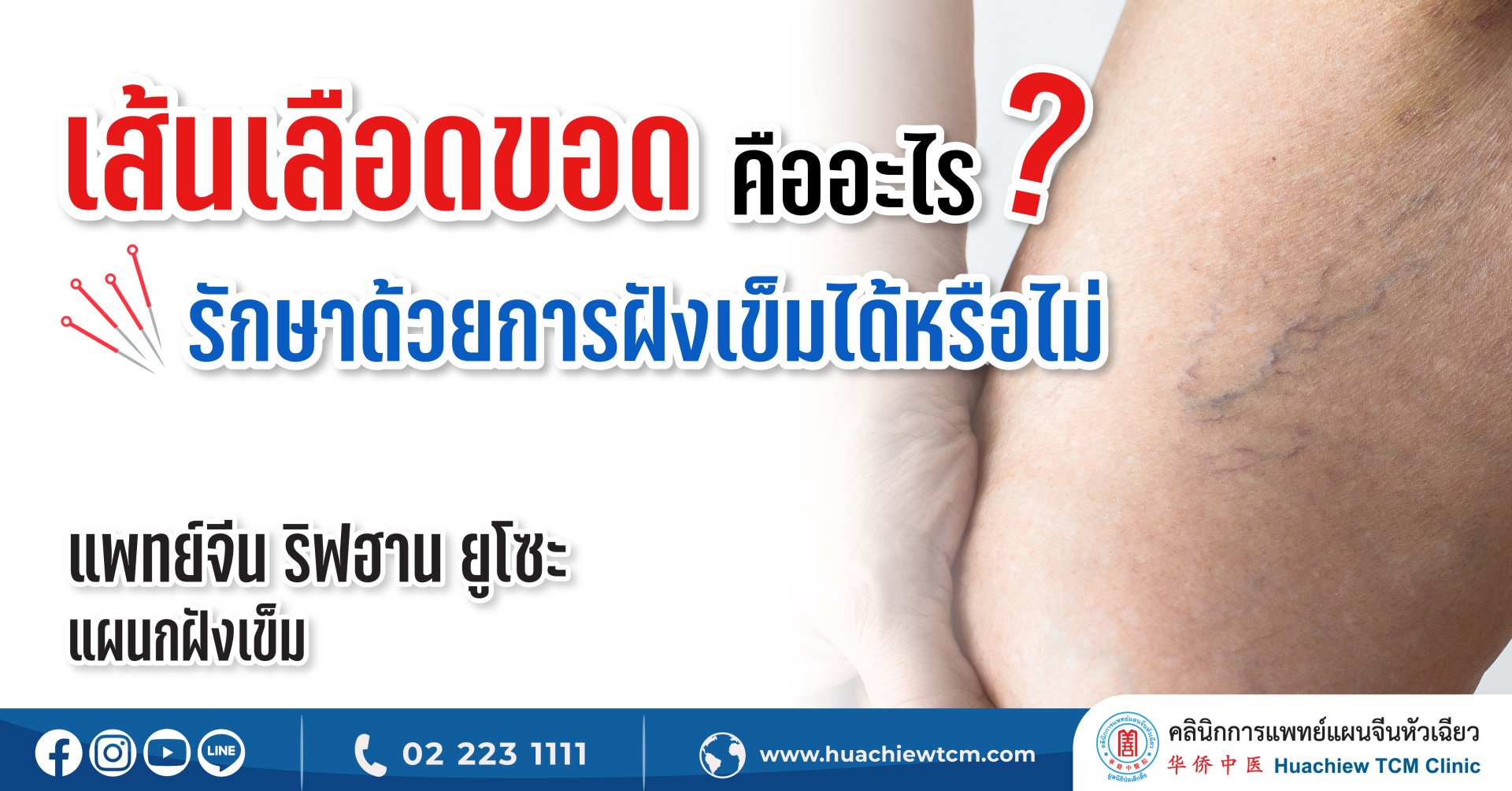 เส้นเลือดขอดคืออะไร รักษาด้วยการฝังเข็มได้หรือไม่ เส้นเลือดขอดคืออะไร รักษาด้วยการฝังเข็มได้หรือไม่