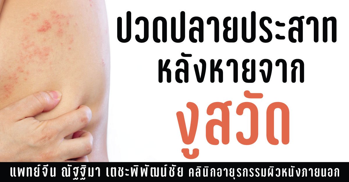 รักษาอาการปวดประสาทจากเชื้องูสวัด รักษาอาการปวดประสาทจากเชื้องูสวัด