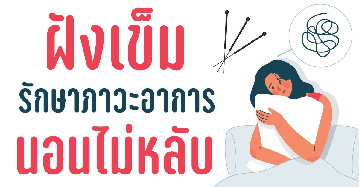 นอนไม่หลับรักษาได้ด้วยการฝังเข็ม นอนไม่หลับรักษาได้ด้วยการฝังเข็ม