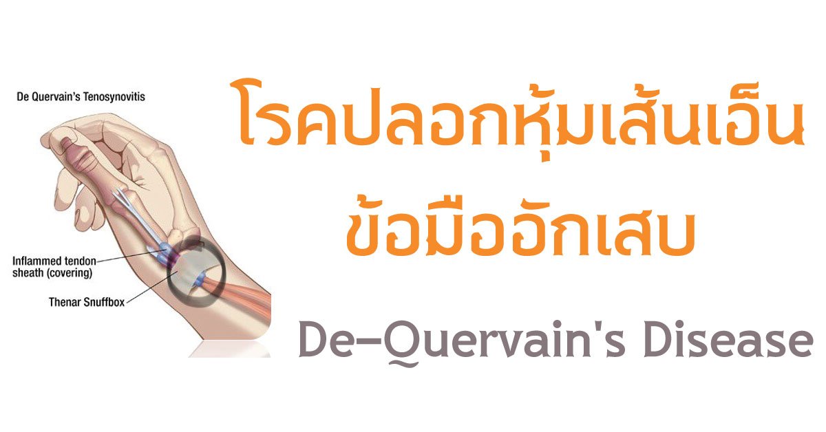 โรคปลอกหุ้มเส้นเอ็นข้อมืออักเสบ โรคปลอกหุ้มเส้นเอ็นข้อมืออักเสบ