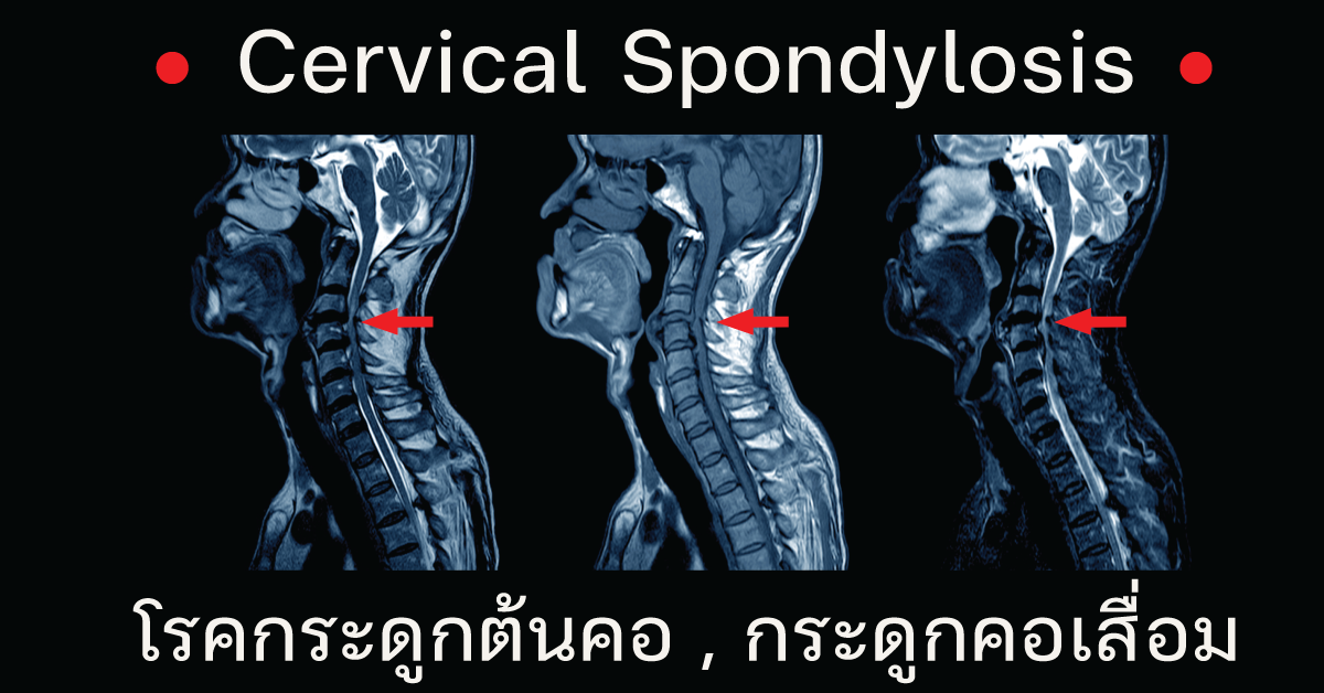 โรคกระดูกคอเสื่อม (Cervical Spondylosis) โรคกระดูกคอเสื่อม (Cervical Spondylosis)