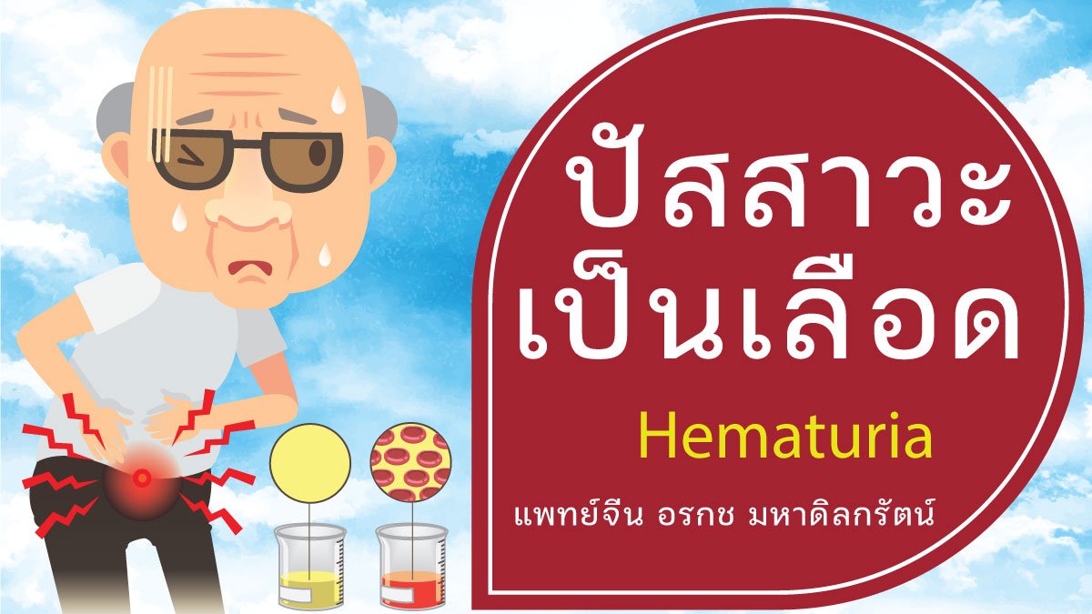 ปัสสาวะเป็นเลือด รักษาด้วยวิธีแพทย์แผนจีน ปัสสาวะเป็นเลือด รักษาด้วยวิธีแพทย์แผนจีน