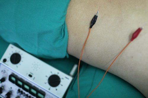 การฝังเข็มร่วมกับกระตุ้นเข็มด้วยไฟฟ้า Electro-Acupuncture การฝังเข็มร่วมกับกระตุ้นเข็มด้วยไฟฟ้า Electro-Acupuncture