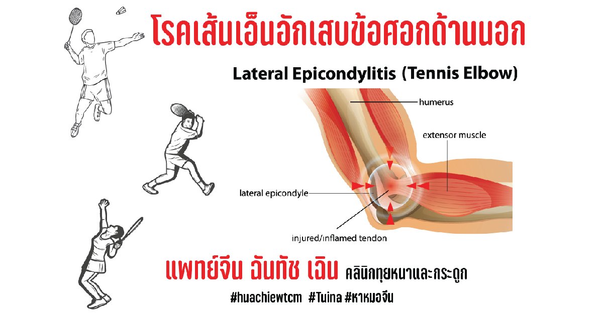 โรคเส้นเอ็นอักเสบข้อศอกด้านนอก LATERAL EPICONDYLITIS:TENNIS ELBOW โรคเส้นเอ็นอักเสบข้อศอกด้านนอก LATERAL EPICONDYLITIS:TENNIS ELBOW