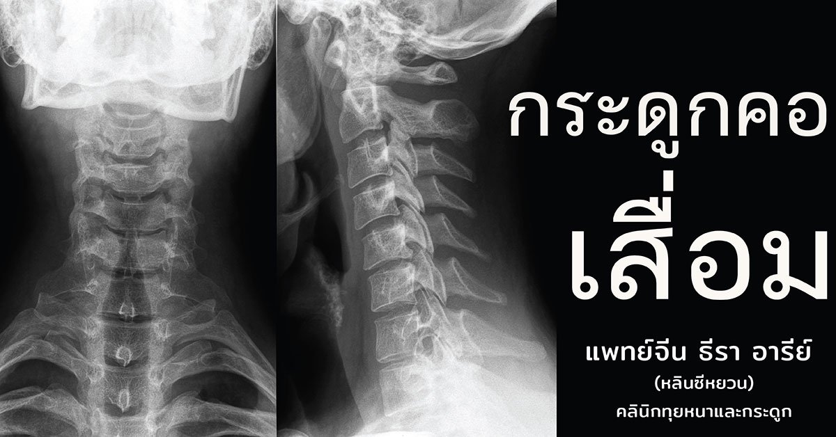 โรคกระดูกคอเสื่อม Cervical Spondylosis โรคกระดูกคอเสื่อม Cervical Spondylosis