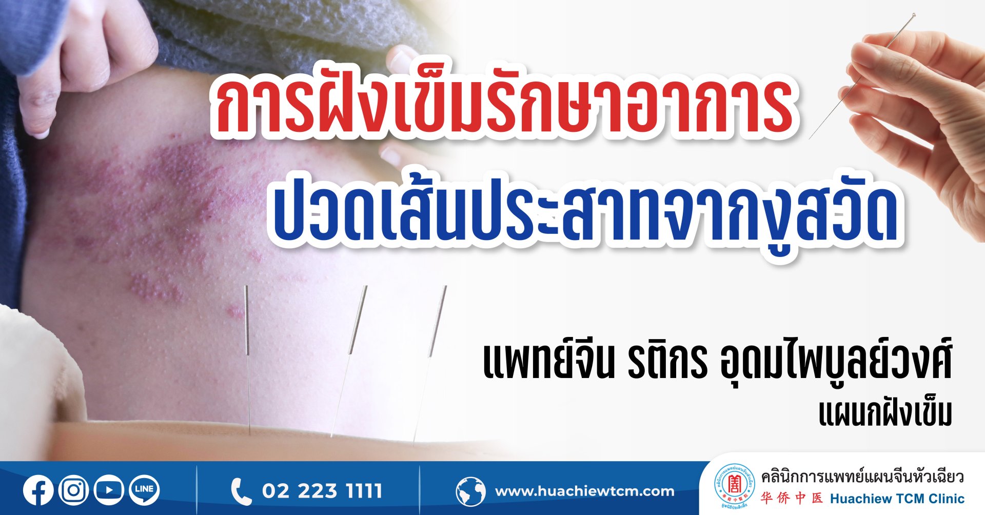 การฝังเข็มรักษาอาการปวดเส้นประสาทจากงูสวัด การฝังเข็มรักษาอาการปวดเส้นประสาทจากงูสวัด