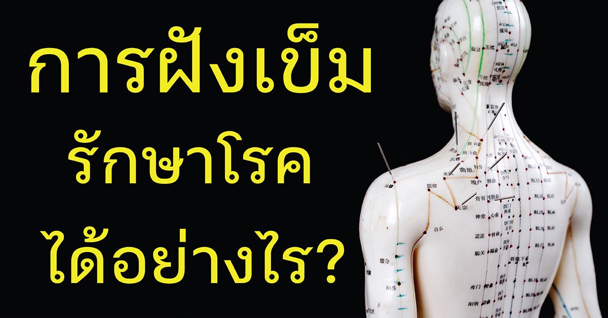 ฝังเข็มรักษาโรคได้อย่างไร ? ฝังเข็มรักษาโรคได้อย่างไร ?