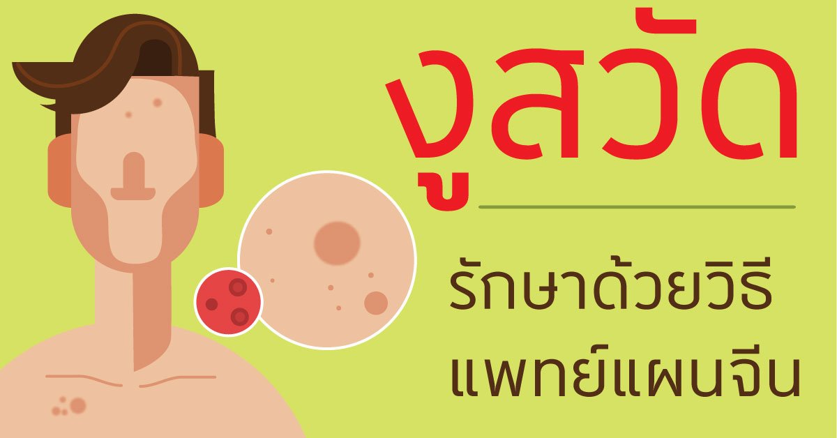 งูสวัด Varicella zoster virus โรคผิวหนังที่หลบซุกซ่อนรอวันปะทุ งูสวัด Varicella zoster virus โรคผิวหนังที่หลบซุกซ่อนรอวันปะทุ