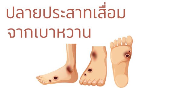 ปลายประสาทเสื่อมจากเบาหวาน ปลายประสาทเสื่อมจากเบาหวาน