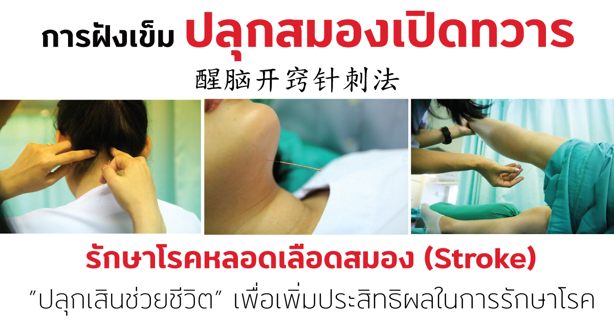 การฝังเข็มปลุกสมองเปิดทวาร การฝังเข็มปลุกสมองเปิดทวาร