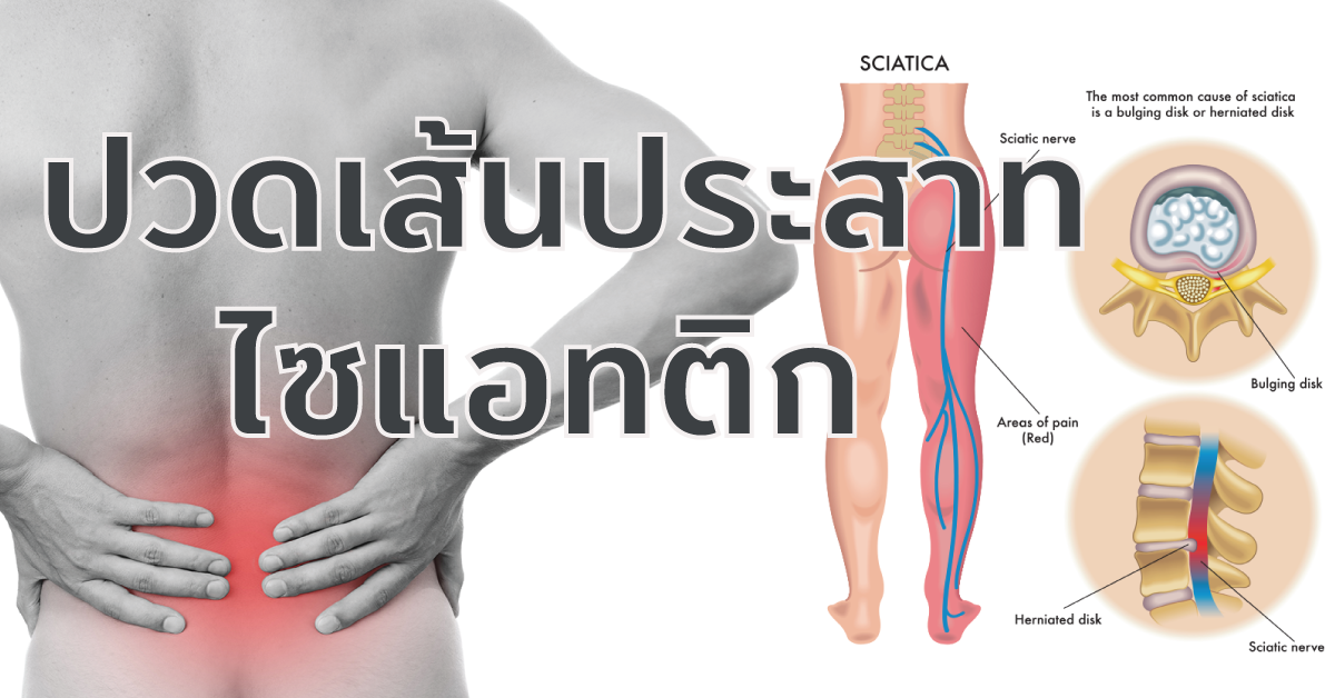 ปวดเส้นประสาทไซแอทติก Sciatica