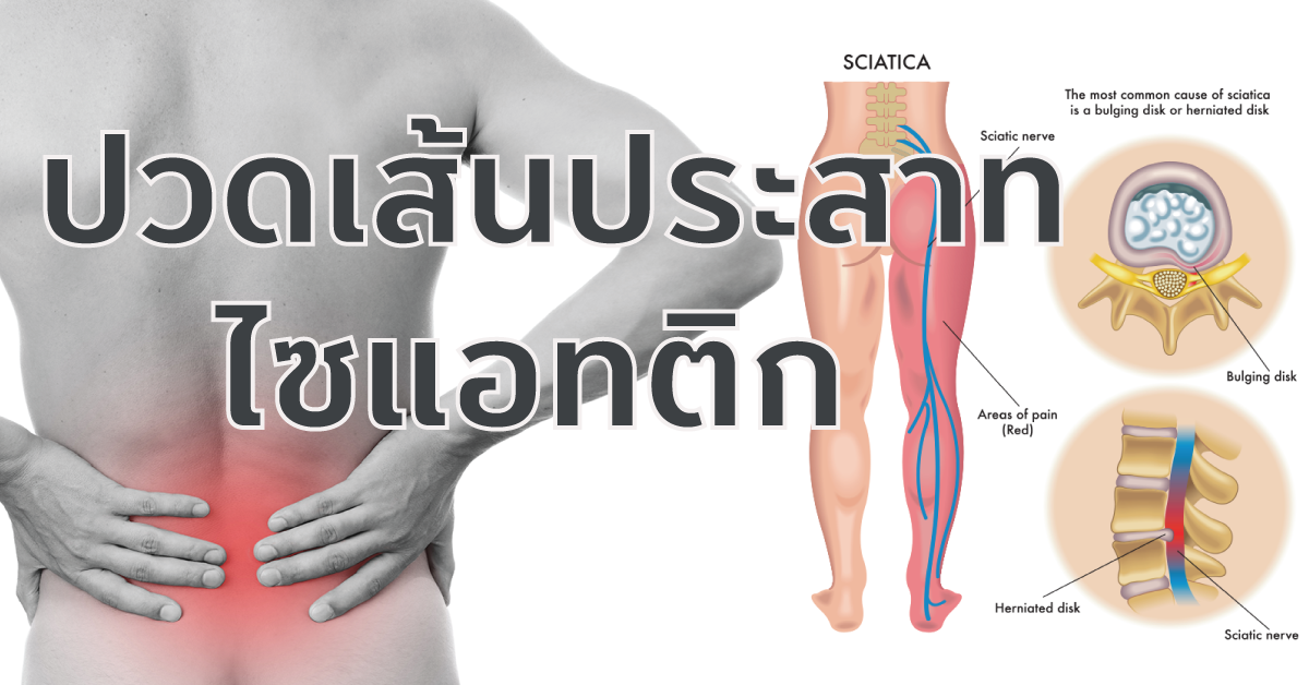 ปวดเส้นประสาทไซแอทติก Sciatica ปวดเส้นประสาทไซแอทติก Sciatica
