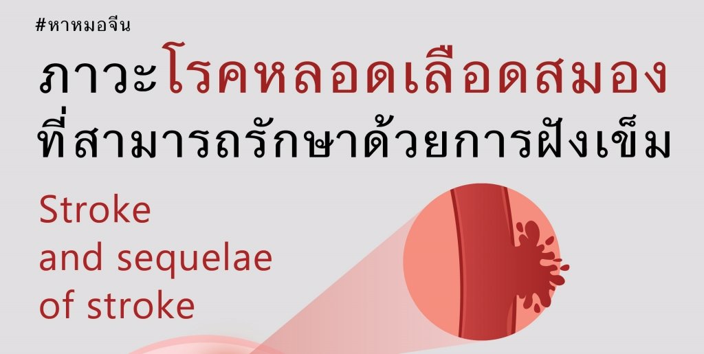 ภาวะโรคหลอดเลือดสมองที่สามารถรักษาได้ด้วยการฝังเข็ม ภาวะโรคหลอดเลือดสมองที่สามารถรักษาได้ด้วยการฝังเข็ม